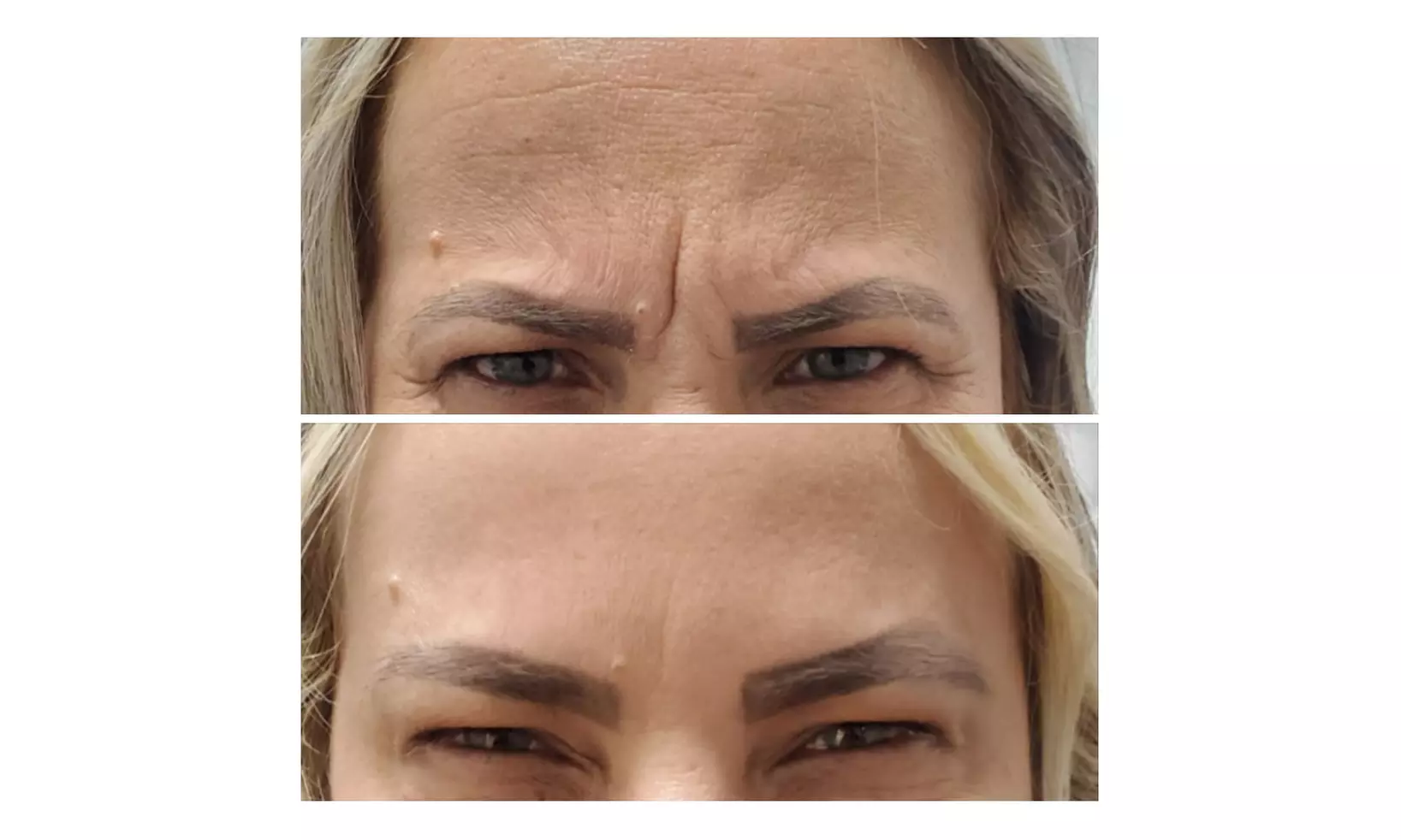 Up to 40% Off on Injection - Botox at Vita Medspa - Oviedo