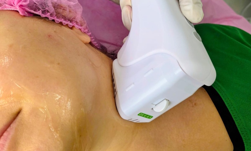 Image 2: One 12D HIFU Facelift  or Skin-Tightening Treatment