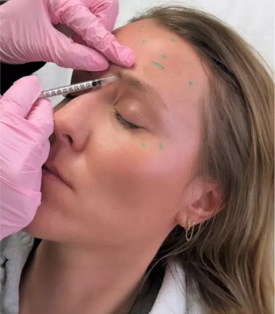 Refresh Your Look with 20 Units of Xeomin Injection