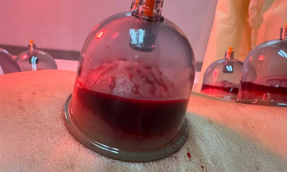 NO WAIT DOCTORS Offers One or Two Sessions of 60-Minutes Medical Cupping (Up to 20% Off) - Second Medium