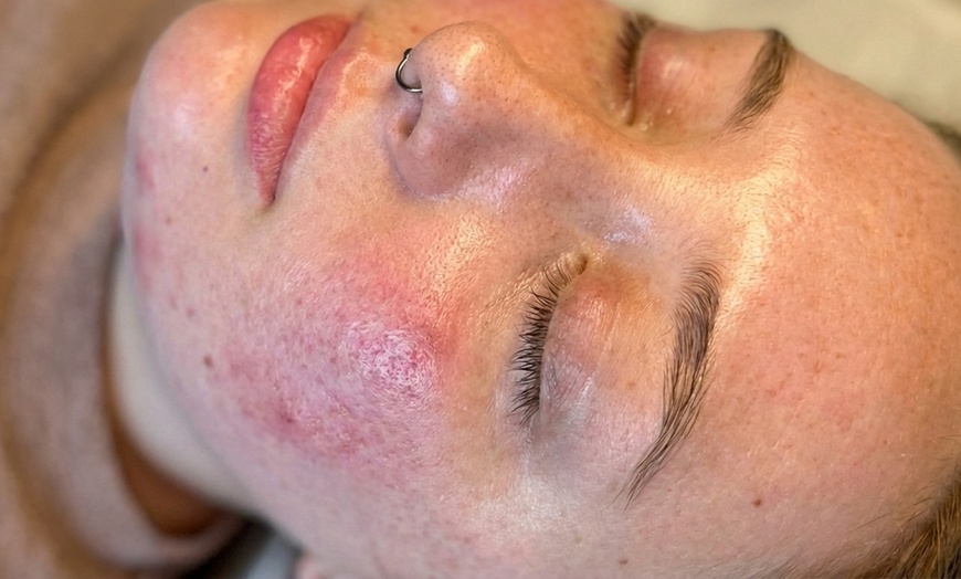 Image 4: One, Two, Three or Four Professional Grade Pro Chemical Peels