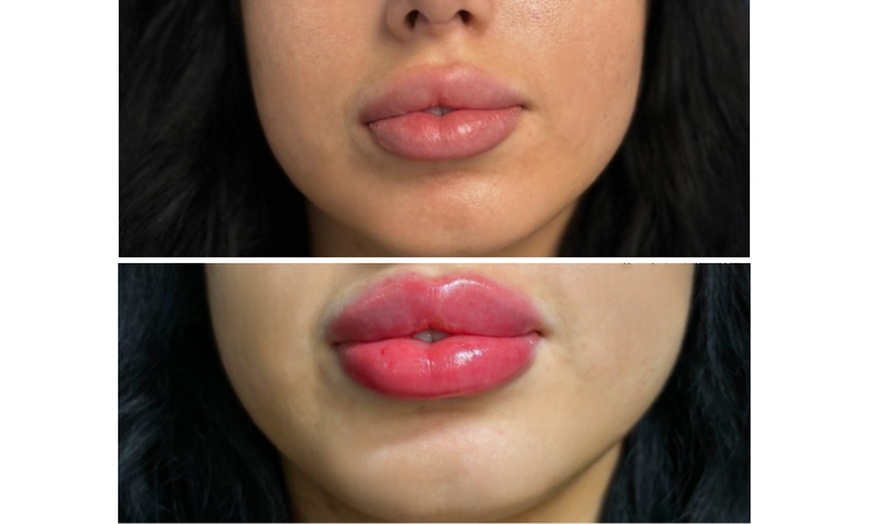 Image 3: Enhance Beauty with One or Half Syringe of Dermal Filler