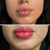 Image 3: Enhance Beauty with One or Half Syringe of Dermal Filler