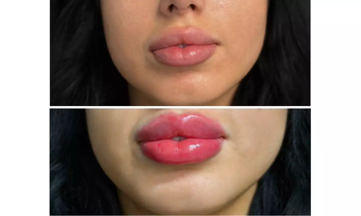 Enhance Beauty with One or Half Syringe of Dermal Filler