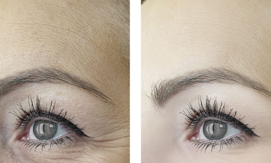 Image 2: 20, 40 Units of Botox or a Syringe of Juvederm Injections
