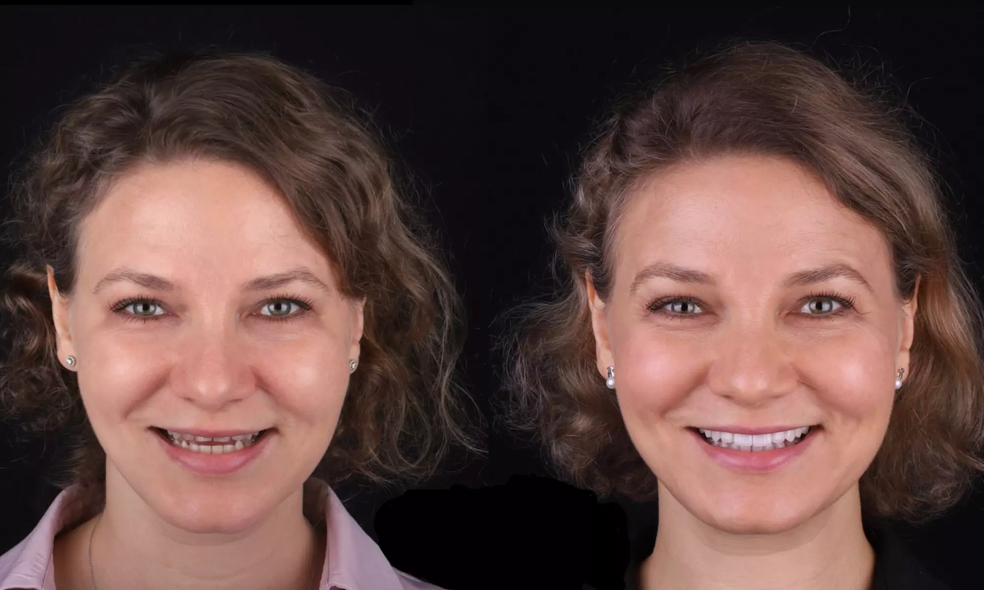 Colocación de hasta 4 carillas dentales de composite o cerámica