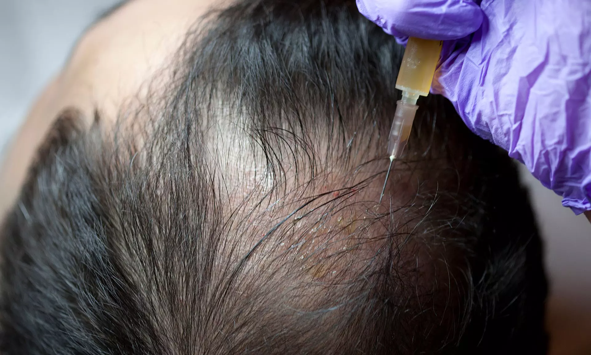 Transform your Look with AK Management Solutions' 1, 2, or 3 PRP Hair Restoration Sessions (Up to 38% Off) - Second Medium