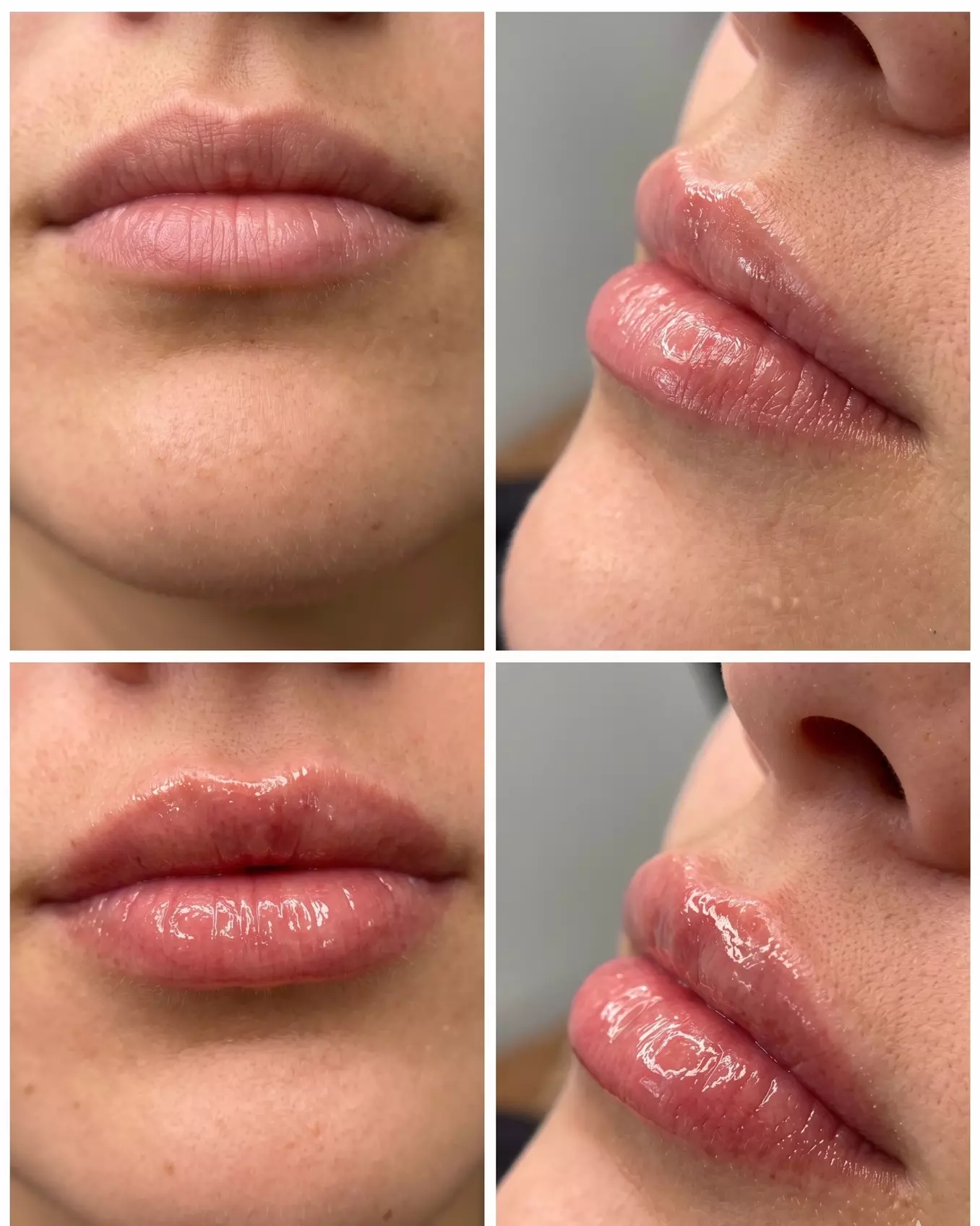 Targeted Dermal Filler Treatments for Lips, Eyes & Facial Lines