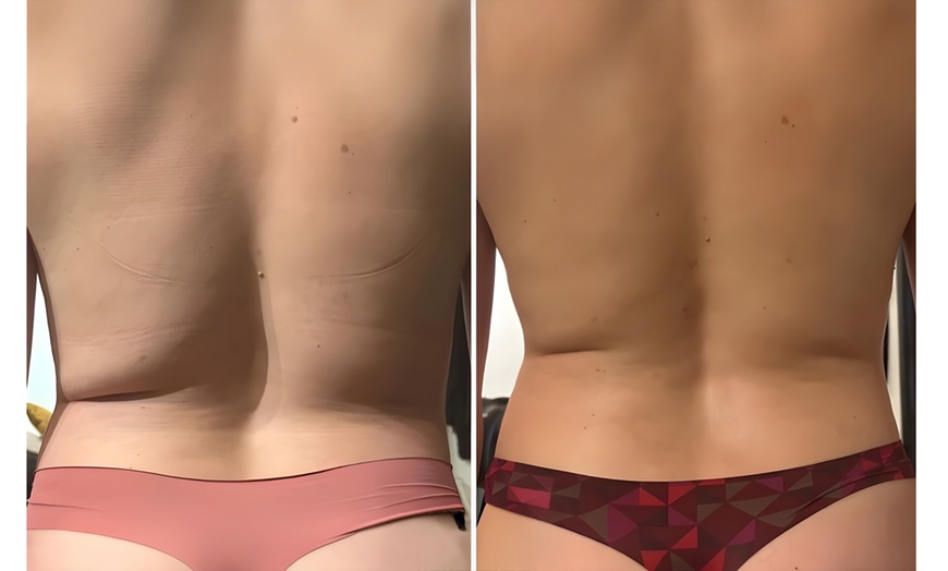 Image 5: 1, 3 or 6 Signature Body Contouring Sessions of Your Choice 45 -90 Min