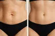 Get VIP Tighten & Tone Membership, Total Face & Body Renewal, Platinum Transformation Package - Up to 30%Off - Second Medium