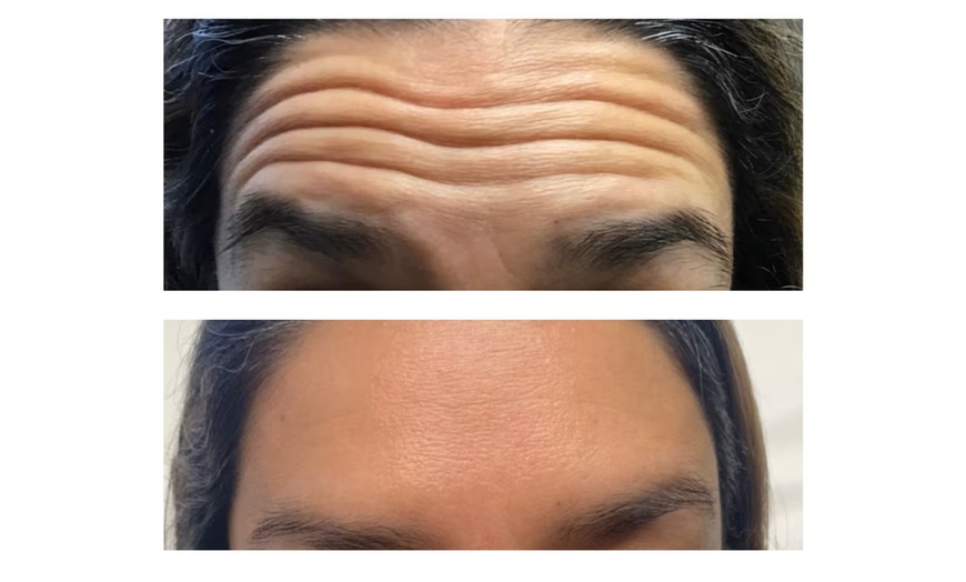Image 5: Experience a Youthful Look with 20 Units of Botox