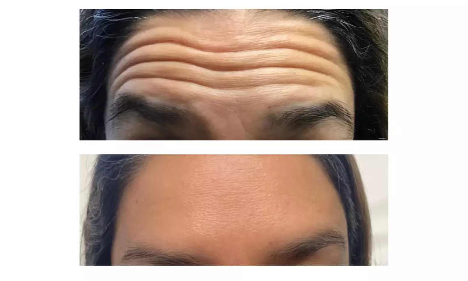 Experience a Youthful Look with 20 Units of Botox