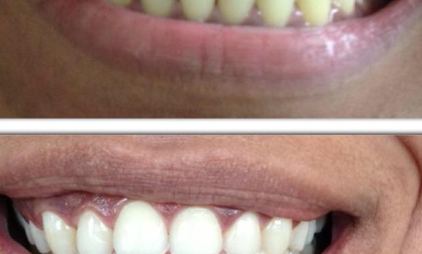 Image 4: LED Teeth Whitening Sessions for a Brighter Smile