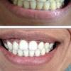 Image 4: LED Teeth Whitening Sessions for a Brighter Smile