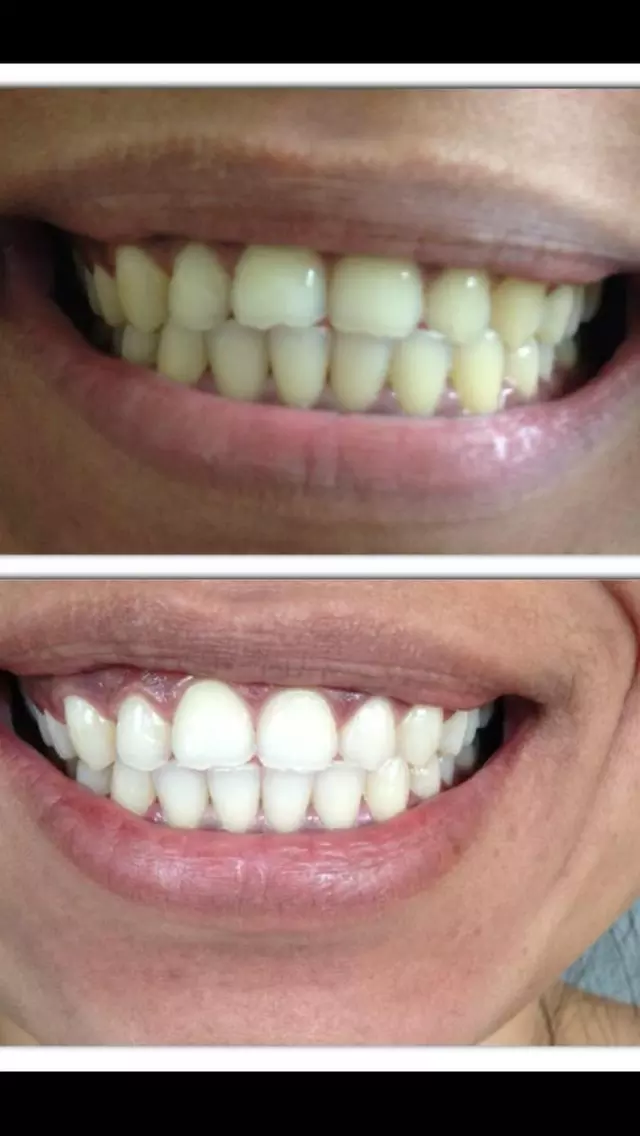 LED Teeth Whitening Sessions for a Brighter Smile