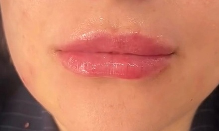 0.5ml dermal filler - Nara beauty Ltd