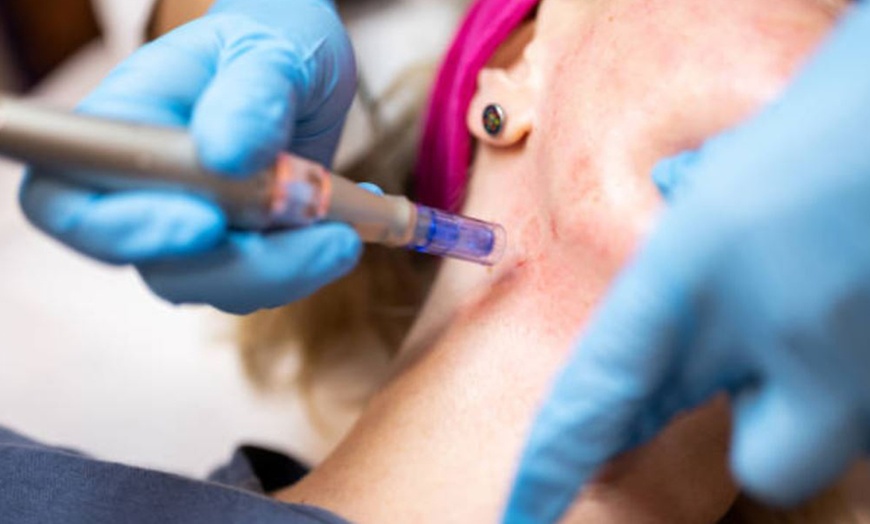 Image 10: Hyaluronpen con hidratación o relleno de labios y reafirmación facial