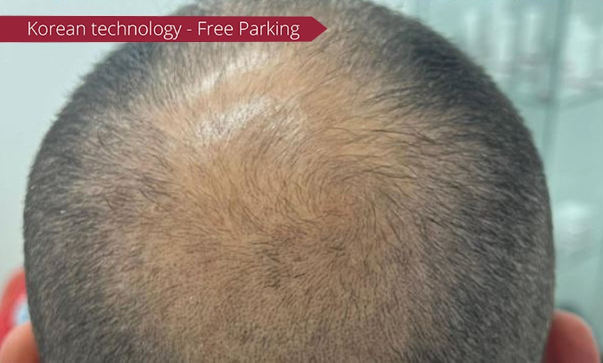 Image 2: 1, 2, or 3 Sessions of Skin Needling & Korean Exosomes for Skin/Hair 