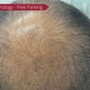 Image 2: 1, 2, or 3 Sessions of Skin Needling & Korean Exosomes for Skin/Hair 