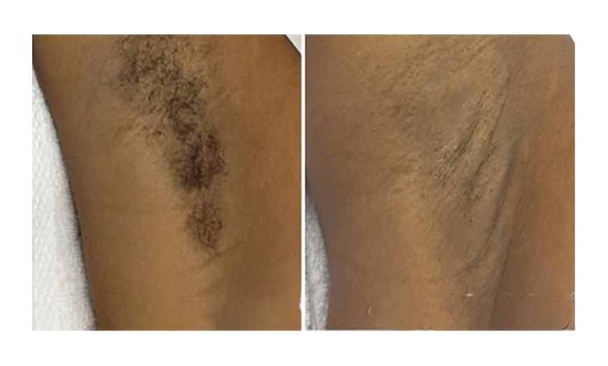 Image 7: 6 Sessions of Aerolase® Neo Elite Laser Hair Removal 