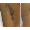 Image 6: 6 Sessions of Aerolase® Neo Elite Laser Hair Removal 