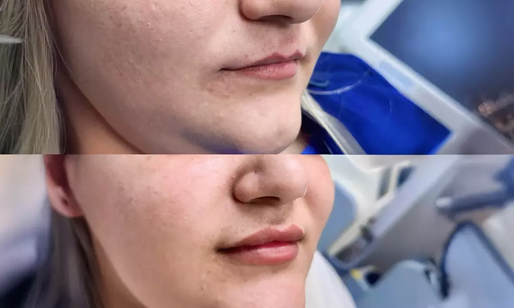 6 Laser Hair Removal Sessions for Any Area Size – Silky Skin Awaits