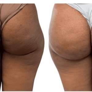 Liquid BBL NEEDLESS - Beauty Magic lyadat sihr al jmaa