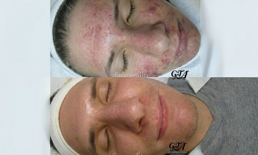 Image 2: Get One, Two, or Three 60 Minute Signature Facial with Smart Peel