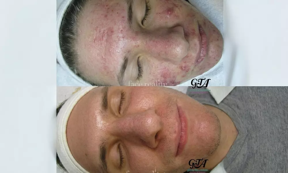 Get One, Two, or Three 60 Minute Signature Facial with Smart Peel