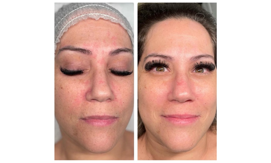 Image 2: Transform Your Skin with One or Two PRP Micro-Needling