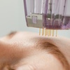 Image 6: Gesichtsbehandlung mit Radiofrequenz-Needling & optionaler Hautanalyse