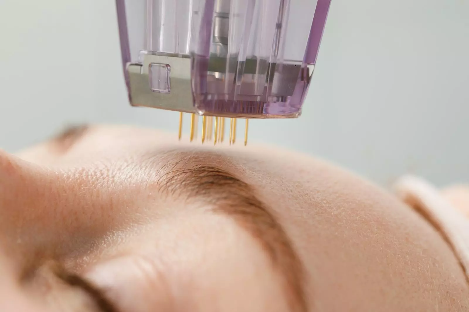 Gesichtsbehandlung mit Radiofrequenz-Needling & optionaler Hautanalyse