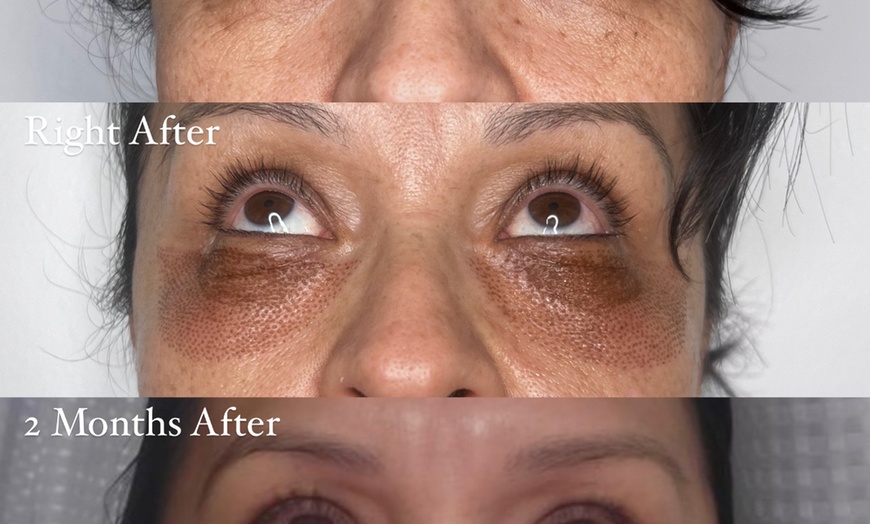 Image 4: Refresh your look with non-surgical blepharoplasty options