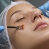 Image 1: One or Two Infusion Or TCA Chemical Peel Facial Sessions for One

