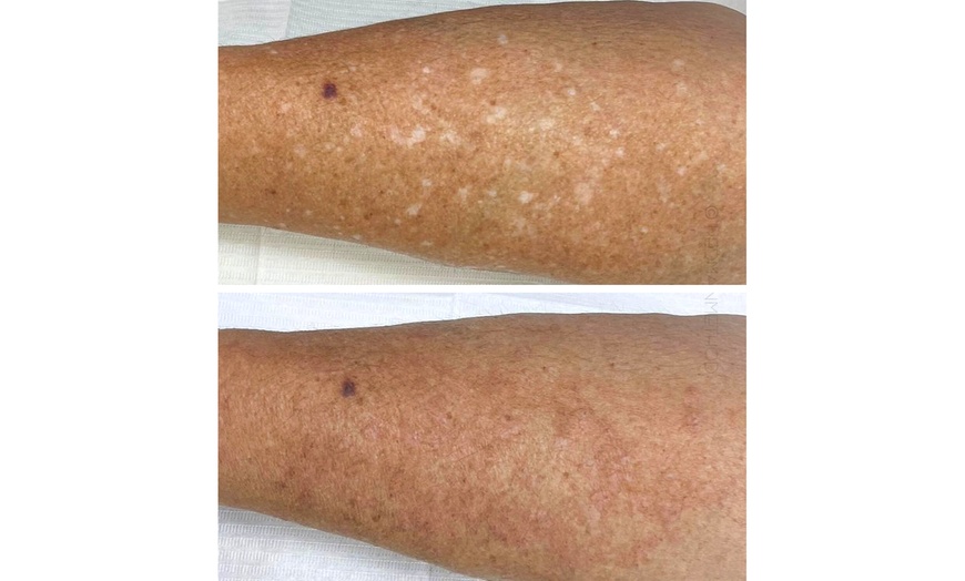 Image 3: Skin Camouflage for Scars, Stretch Marks & Vitiligo (1–3 Sessions)
