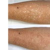 Image 3: Skin Camouflage for Scars, Stretch Marks & Vitiligo (1–3 Sessions)
