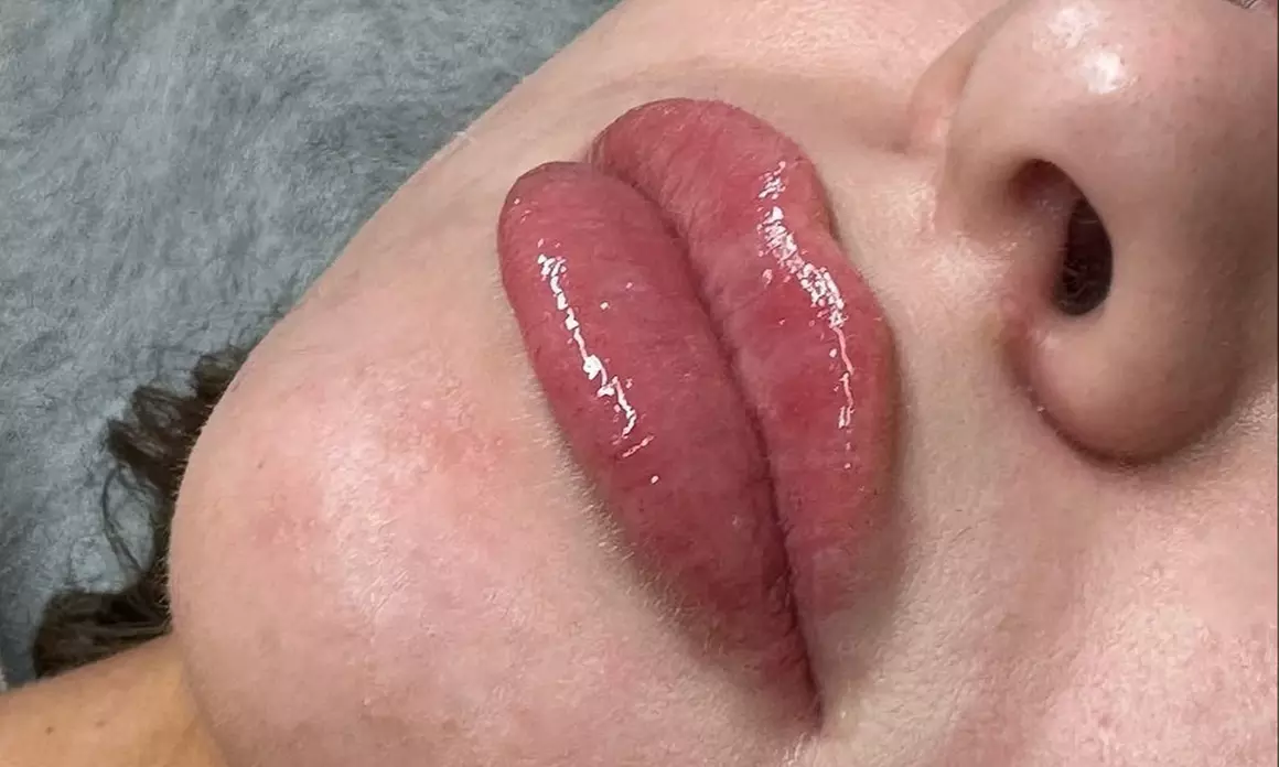 Enhance Your Lips with Russian Lip Enhancement Treatment