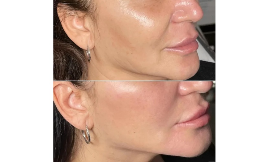Image 2: Wrinkle-Reducing Injectable Treatment for a Refreshed Look