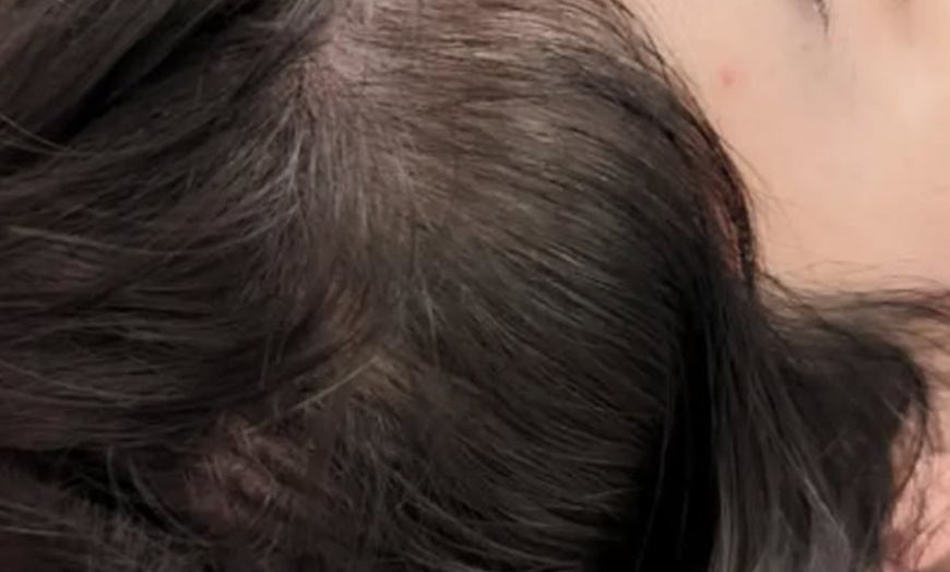 Image 2: Comprehensive Scalp Micro Needling Session -One, Three or Five 60 Min 