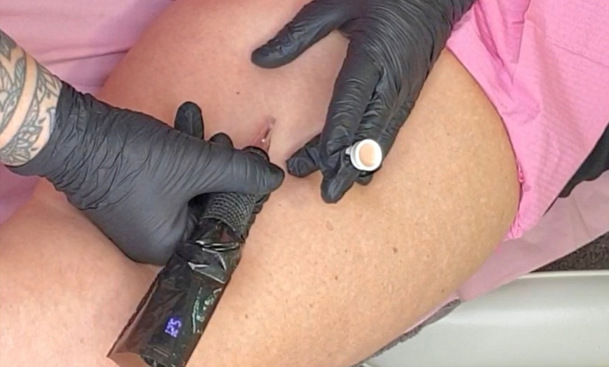 Image 3: Tratamiento de nanopigmentación de estrías con o sin pigmentos 