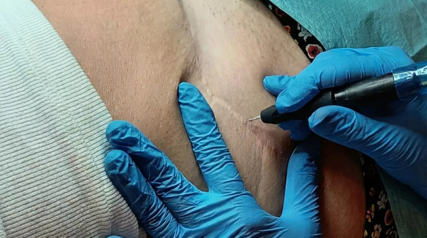 Effektive Pigmentierung blasser und flacher Narben für 1 Person