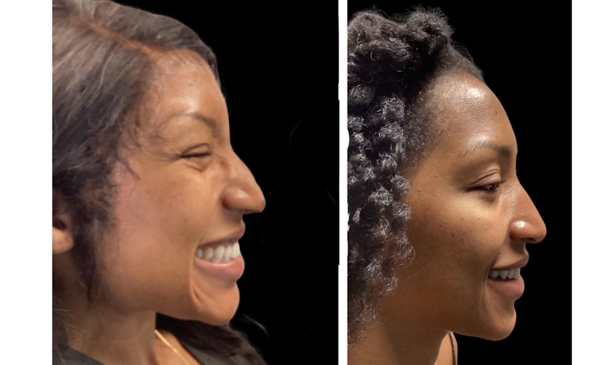 Image 5: Refresh Your Look with 20 or 40 Units of Xeomin