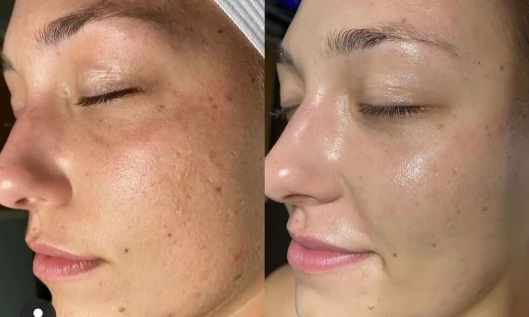 Up to 46% Off on Facial - HydraFacial at Simple Healthy Secrets - Primary Image