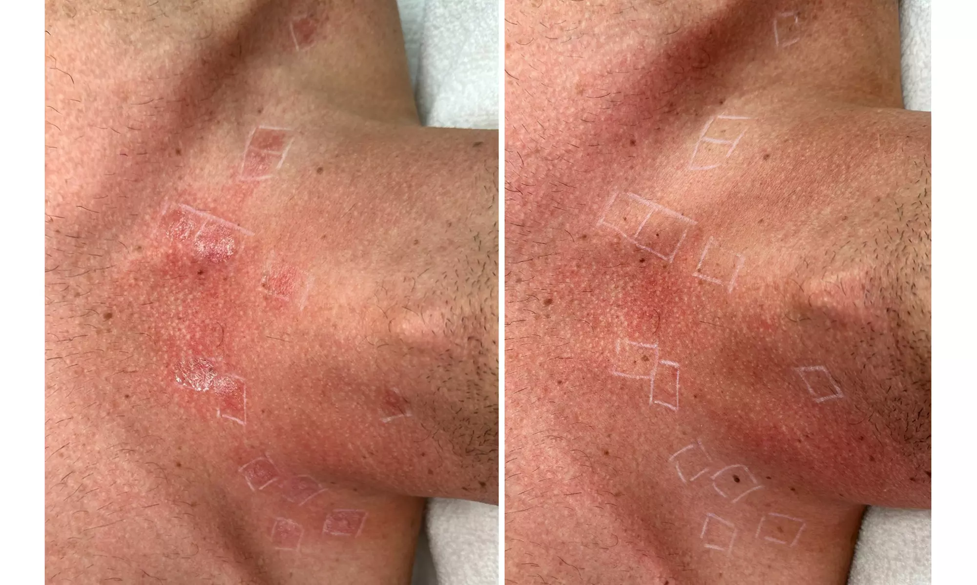 Remove Up To 10 Skin Tags, Moles, Warts Or Milia Up To 2mm