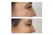 20 or 40 Units of Wrinkle-Reducing Cosmetic Injectable at Perfecta Cosmetic Clinic (Up to 72% Off) - Second Medium