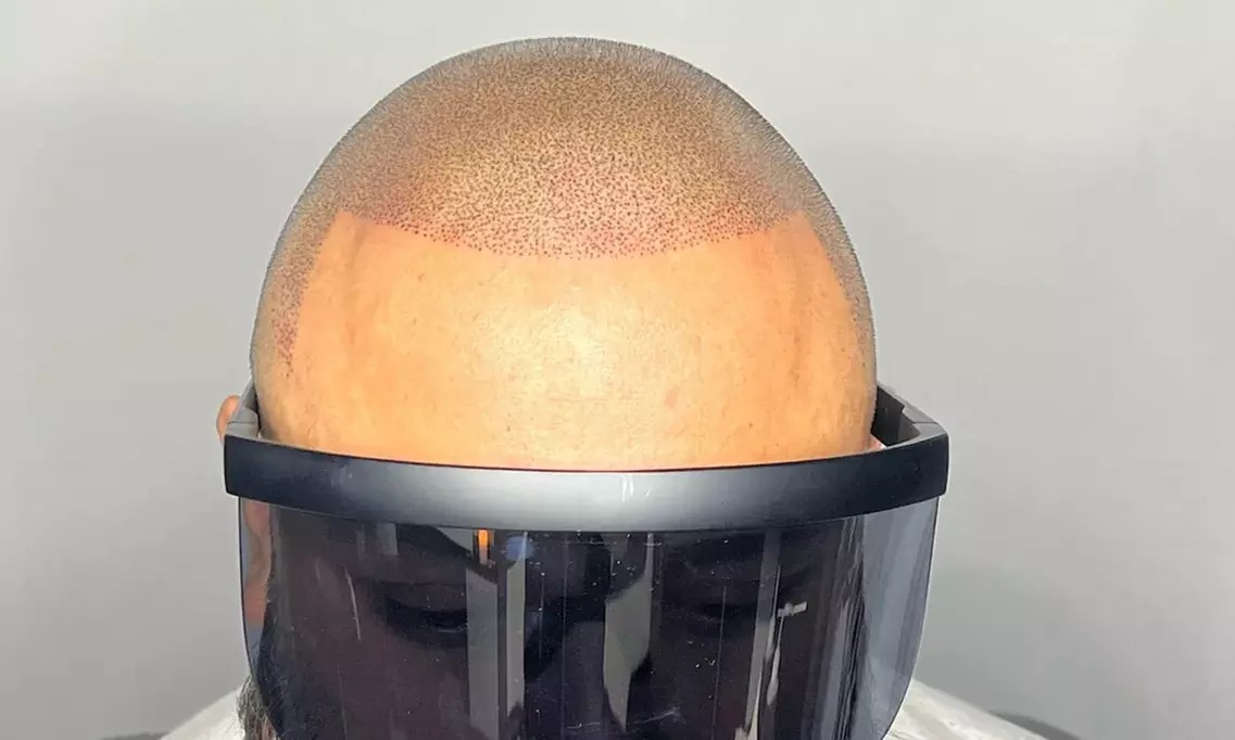 2 or 4 Hour Scalp Micropigmentation for Hairline and Crown Restoration