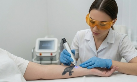 One Laser Tattoo Removal Session on a Small Area - ZMD Aesthetics