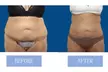Fat Buster or The Works – Body Consultation, Composition Analysis, & Skin Tightening Treatments (Up to 76% Off) - Second Medium