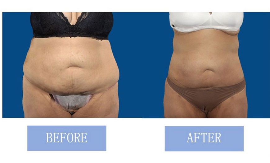 Image 6: Fat Buster or The Works – Body Consultation, Analysis, or More