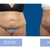 Image 6: Fat Buster or The Works – Body Consultation, Analysis, or More